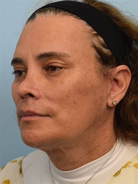 Before & After Face & Neck Lift Bellaire | Face Forward