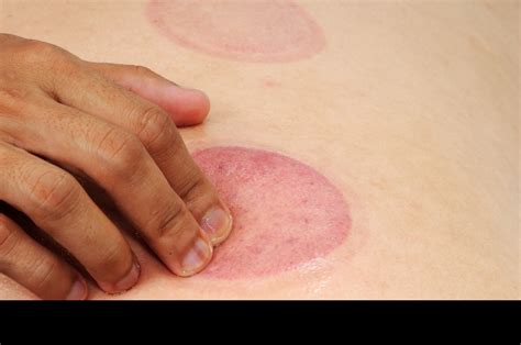 Does Facial Cuping cause bruises, marks, or broken capillaries – The