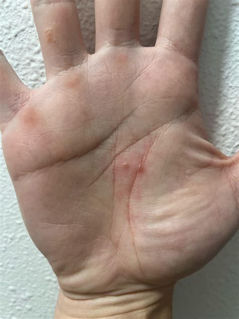 Two Painful/Itchy Bumps on palm and itchy group of bumps on ring finger