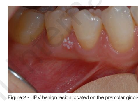 Hpv Tongue Lesions