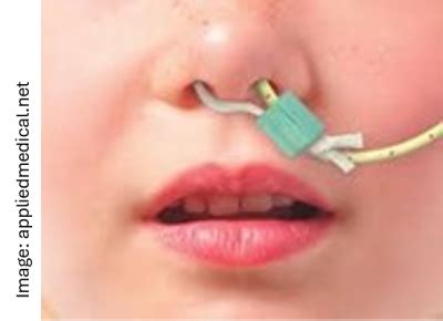 Nasal bridle securement device :: Kingston and Richmond NHS Foundation