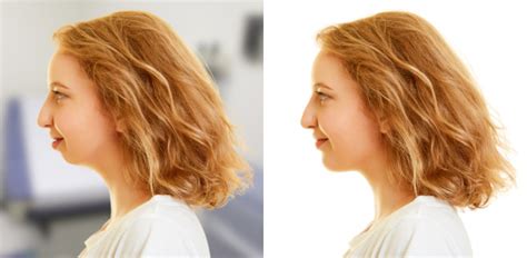 Chin surgery - Genioplasty - Surgical before-and-after simulator