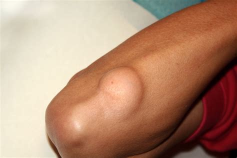 Flank Liposuction: Before and Afters, Cost, Recovery and Results