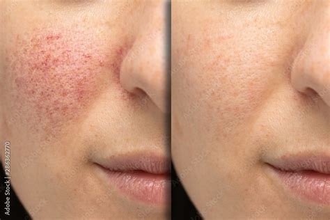 Before and after laser treatment for rosacea Stock Photo | Adobe Stock