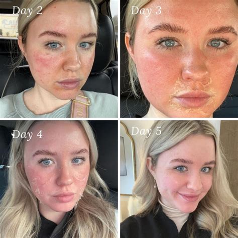 chemical peel  jackson ms skincare treatment faces