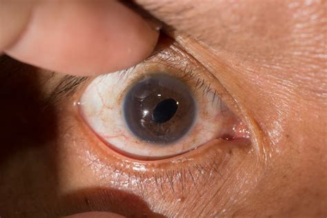Cataract Symptom Score at Patrick Bautista blog