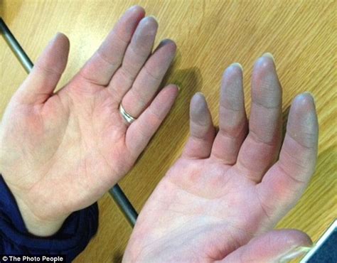 scientists edge closer   cure  chronic cold hands