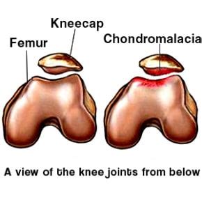 Chondromalacia Patella - Pro Knee Pain Relief