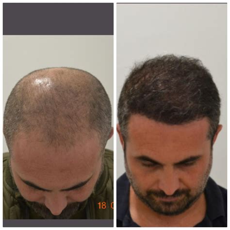 how long to stay in turkey for hair transplant