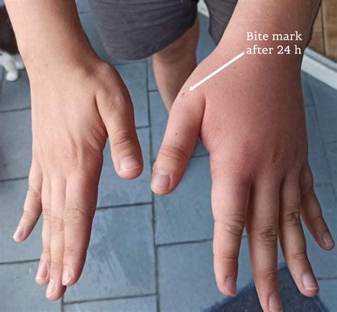 comparison   condition   hand  hours post bite edema