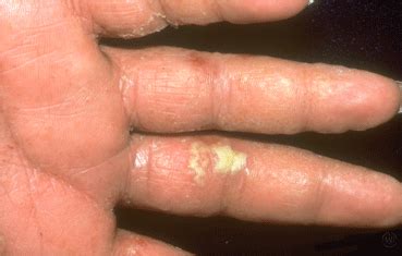Dyshidrotic eczema - Dermatologist in Beverly Hills, MI | Beverly Hills ...