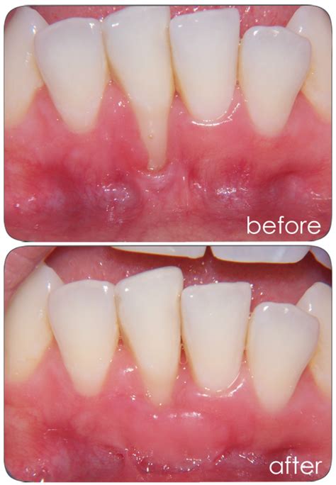 Gingival Graft Before And After