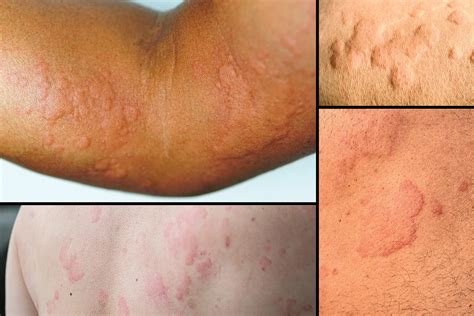 itchy skin hives
