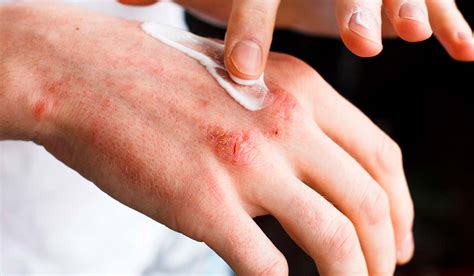 Dermatite De Contato Tem Cura - Dermatite De Contato Tem Cura : O que é Dermatite, causas, tratamentos ...