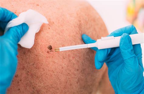 expect     skin tag removal