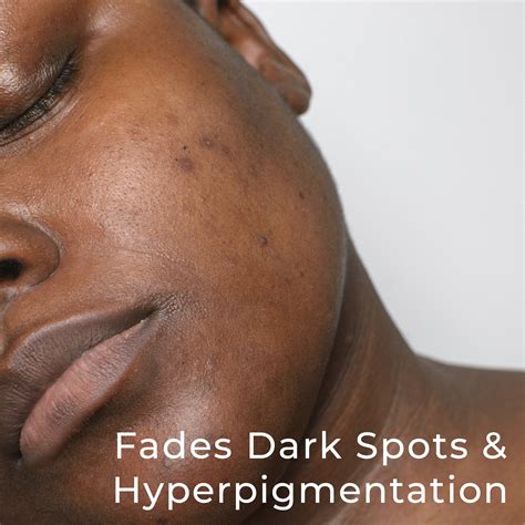 Best Hyperpigmentation Face Masks | Sulina Shop
