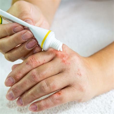 dermatologists favorite products  eczema care cornerstone