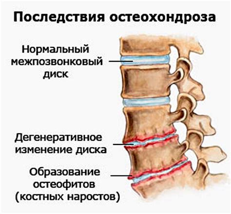 Полісегментарної остеохондроз: що це таке і як його лікувати ...