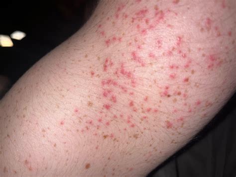 Could this be a tick borne illness? : r/DermatologyQuestions