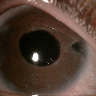 Comparison of conventional Ahmed glaucoma valve (AGV) implantation ...