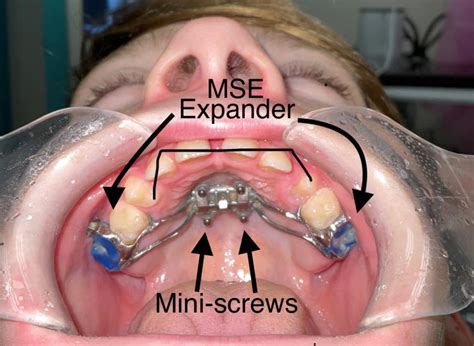 Maxillary Skeletal Expansion (MSE) | Dentist Arlington, VA