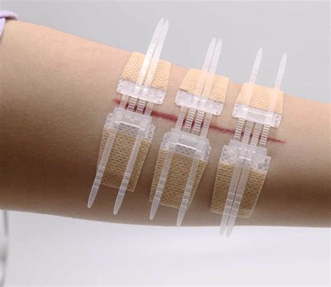 Zip Stitch Surgical Adhesive Tape Wound Dressing Wound Closure Device