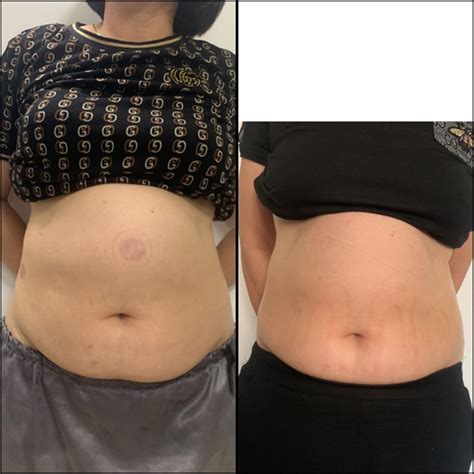 bung sau sinh nhan biet cach xu ly giam beo bung sau sinh