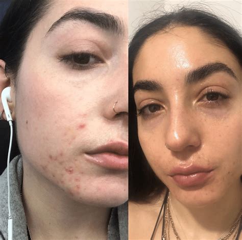 My Accutane journey and experience with isotretinoin • BREAKEVEN