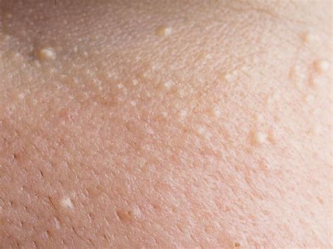 What Are All These Tiny Bumps On My Arm