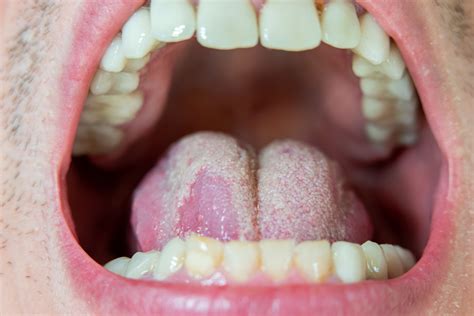 Cómo saber si tengo una infección en la lengua por hacer un oral sin ...