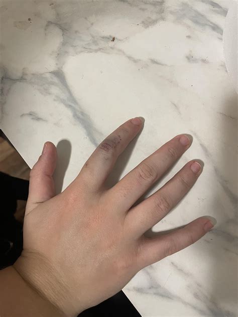 how to cover up bruises 5