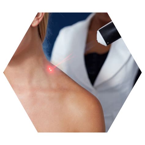 cold laser burlington physiotherapy  sports medicine centre