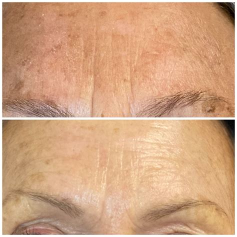 Jet Plasma | Skintopia Scottsdale