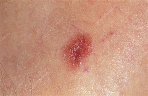 Melanoma Skin Cancer On Back