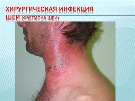 Флегмона. Классификация - online presentation