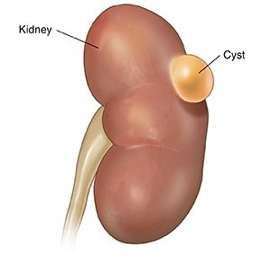 Kidney Cyst Symptoms And Treatment Options - Ask The Nurse Expert