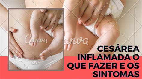 O Que Passar Na Cesárea Inflamada