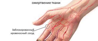 Облитерирующий эндартериит: лечение, симптомы, осложнения