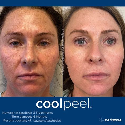 CoolPeel CO2 Laser Resurfacing Treatment in Jacksonville, Florida ...