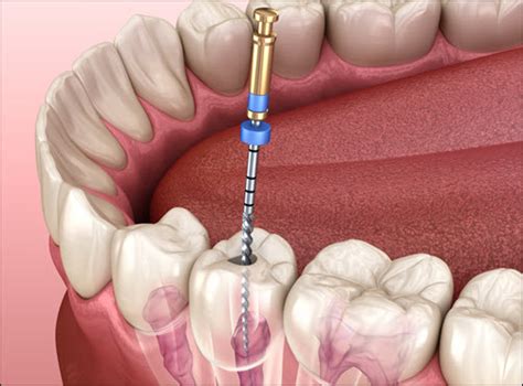 Root Canal Recovery Tips - Shpritz Family Dental