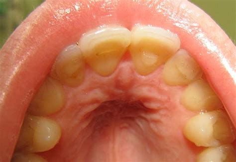 Bulimia nervosa - Wikipedia