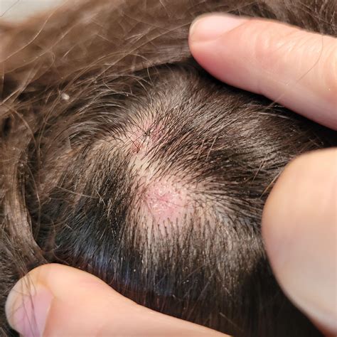 Itchy scalp rash/lesions : r/Dermatology