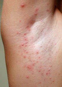 Alergia Após Depilação A Laser Como Tratar - Alergia a depilação - sintomas e como evitar