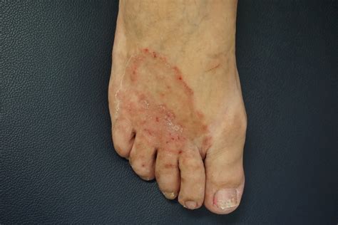 Thick scaly red plaques - Healthed