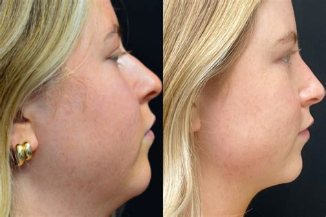 Rhinoplasty Before & After Photos Encinitas, CA