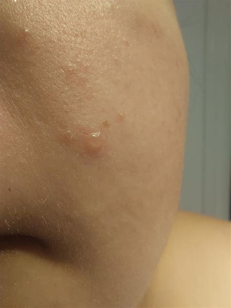 Noticed this little bump on my cheek. Not bothersome but will leak