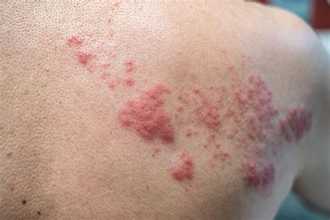 shingles disease herpes zoster varicella zoster virus skin allspine