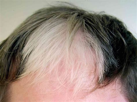 Poliosis: What To Know About Causes and Symptoms
