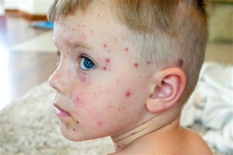 Chickenpox Rash