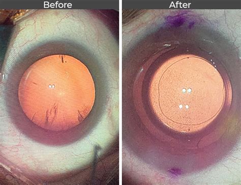 Cataract Before & After Pictures in Los Angeles